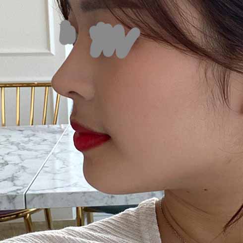 무보형물 3개월차 후기입니다