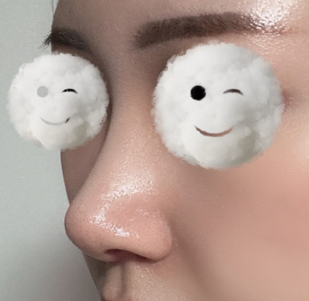 보형물없이 이쁘게 코 높힌 후기!