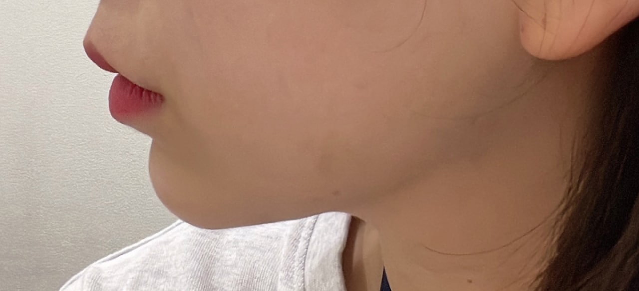 얼굴지흡+턱끝필러+턱보톡스 맞았어용