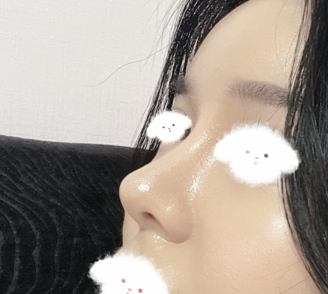 낮은복코성형 성공적ㅎㅎ