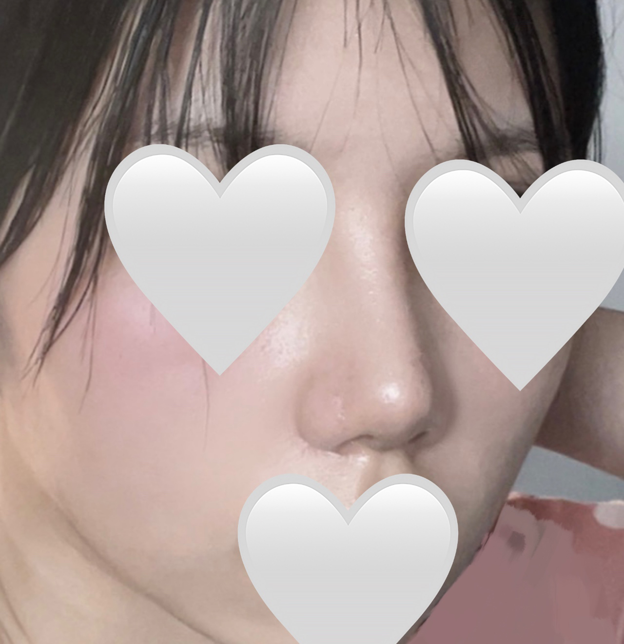 복코성형한지 3주지났어용!