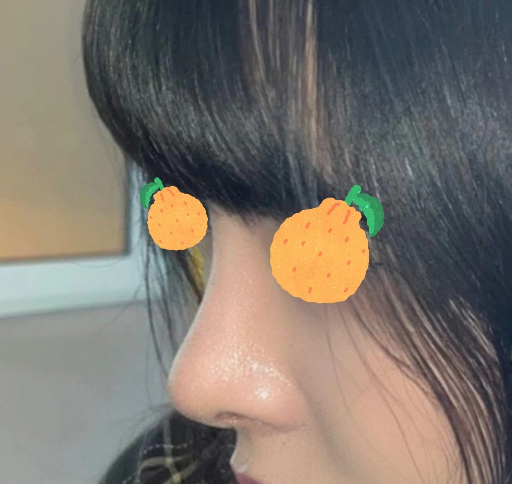 코수술하길 잘했어요 ㅎㅎ 행복행복