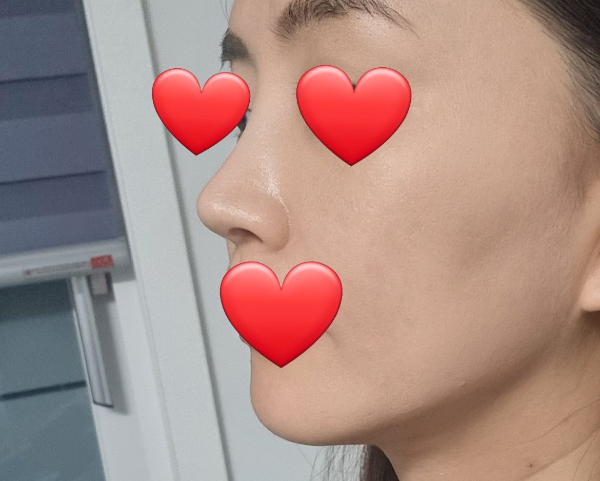 3번째코재수술, 이중턱지방흡입했습니다~