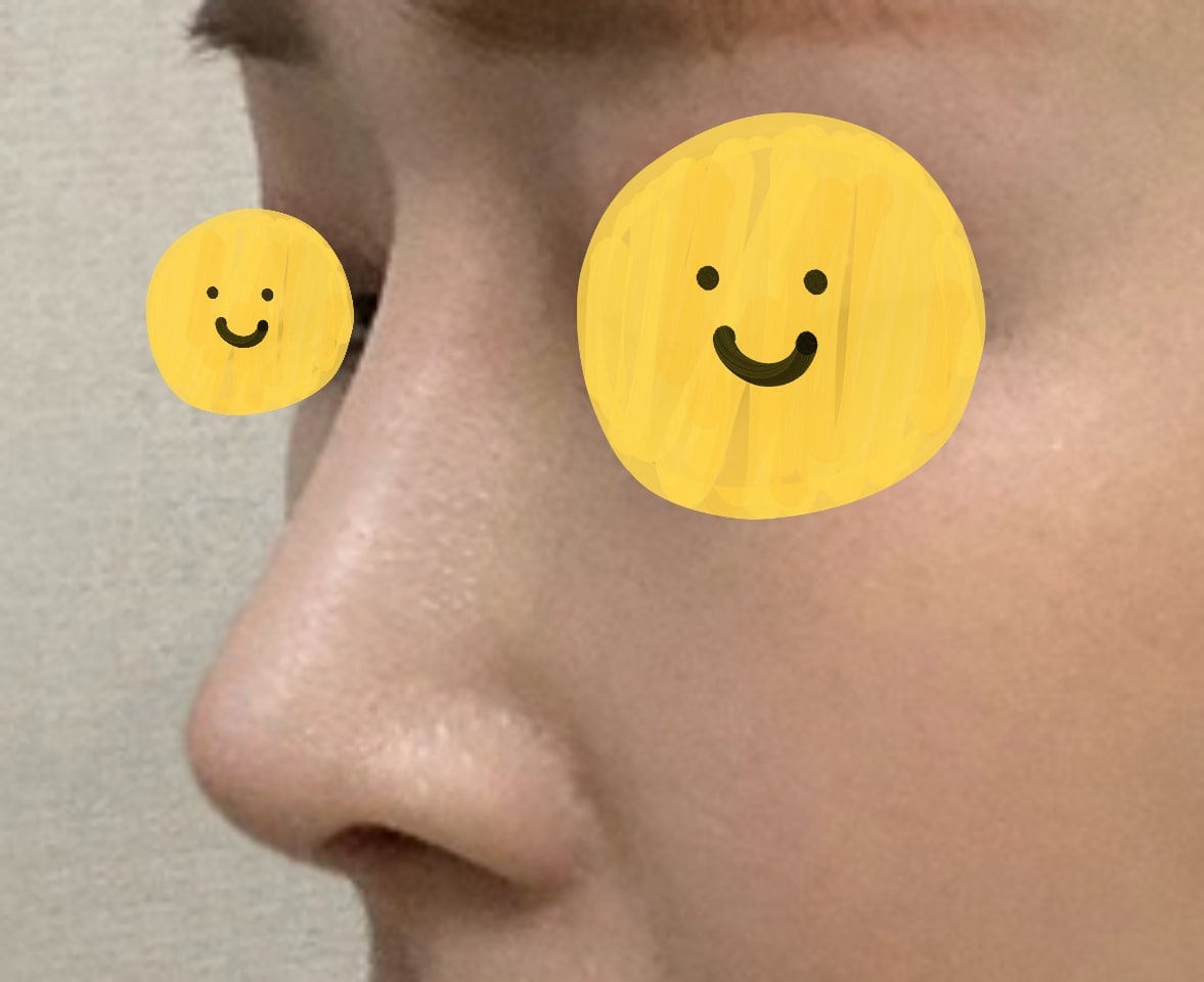 원하던 코 라인으로 나왔어요~