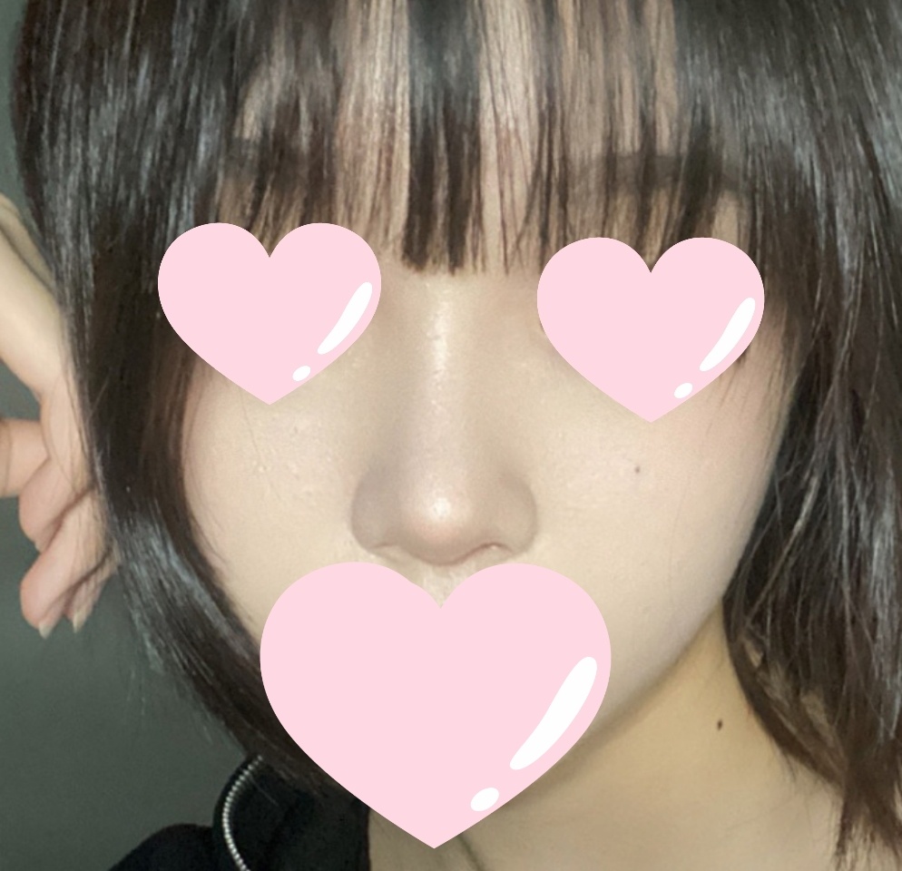 복코수술효과 잘보고 있어욥