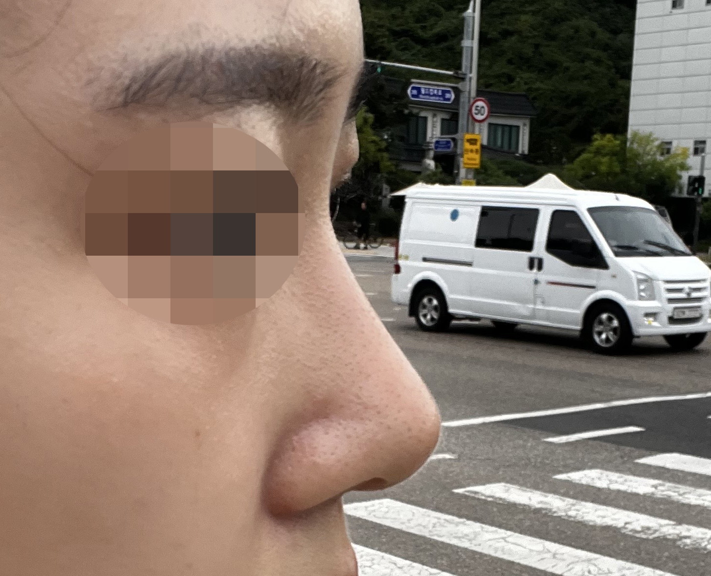 눈성형+코성형 7개월차:)