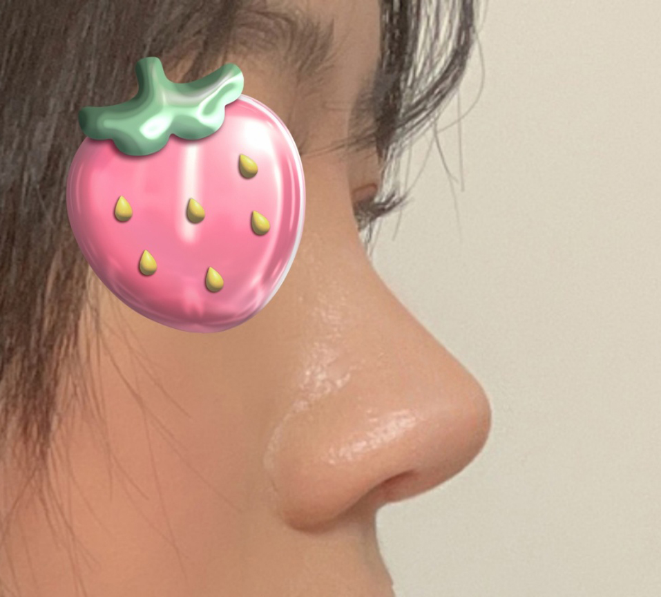 코재수술 만족해용!! ㅎㅎ