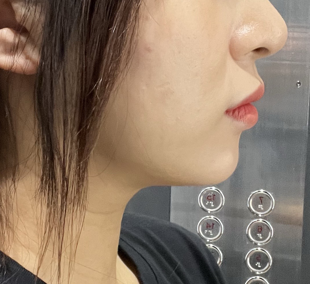 점점 턱라인이 갸름해지는게 보여요 ㅎㅎ