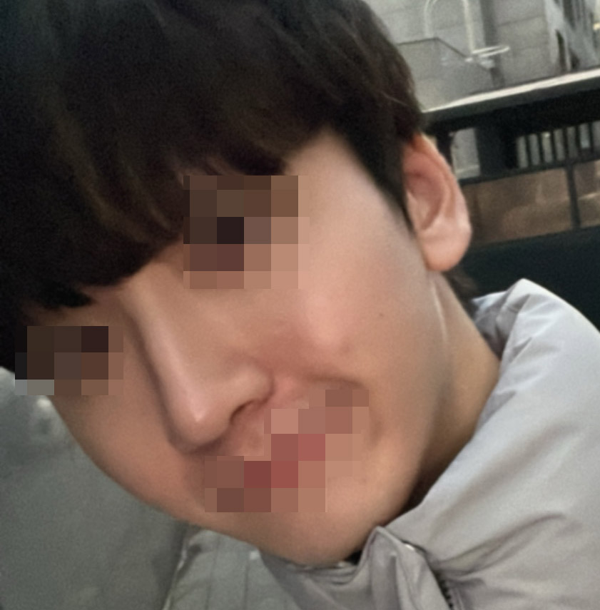 남자코성형 바이브 완전 추천bb