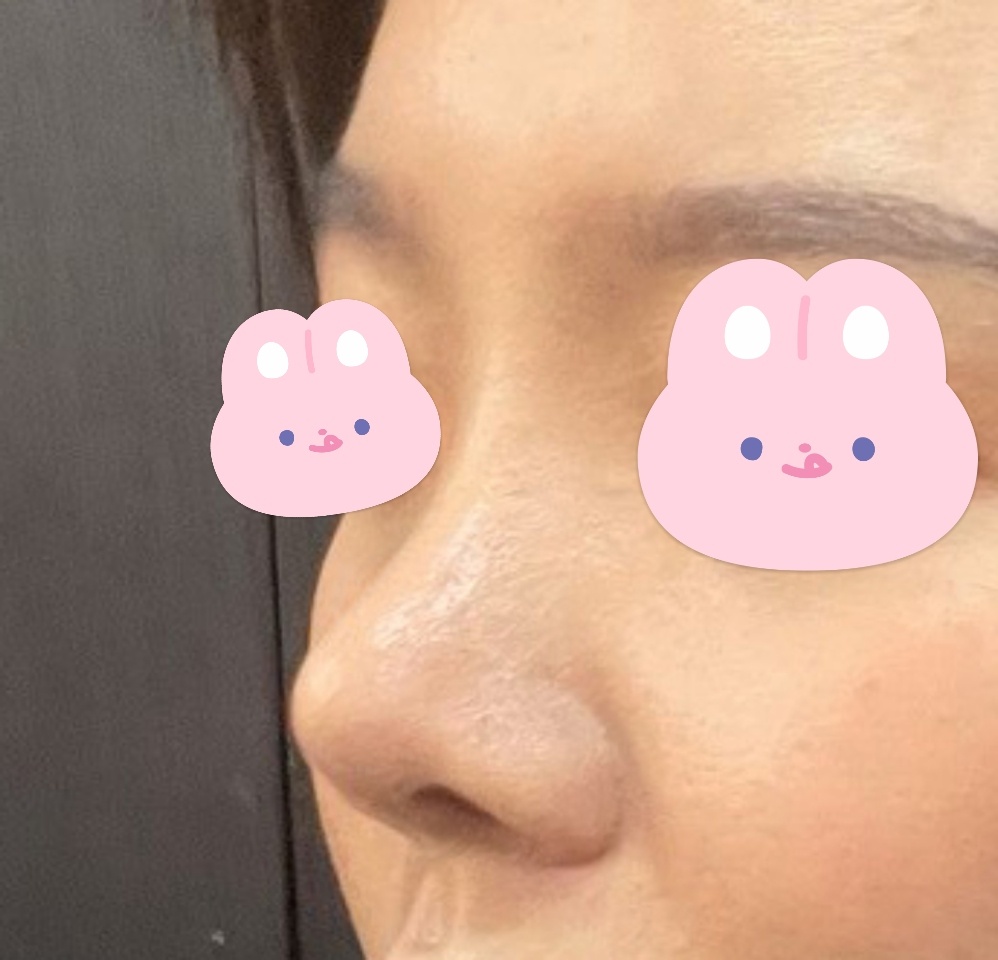 유영문원장님께 눈, 코수술받았어요-4개월차!