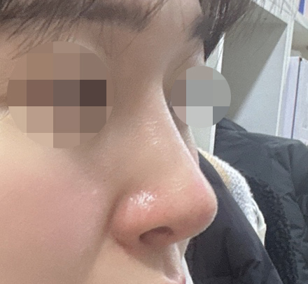 지금은 제 코같이 불편함 없어요:)