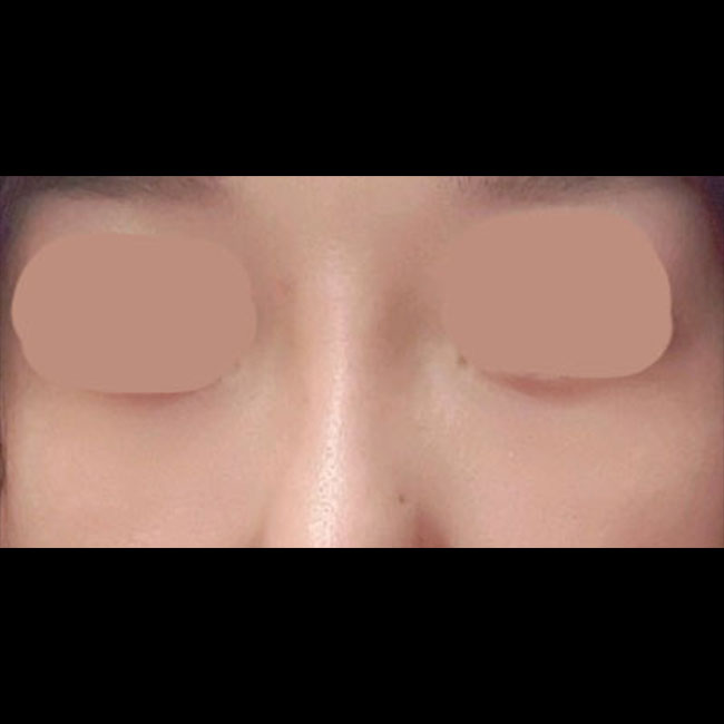 여름에 하안검 수술하고 후기써요~