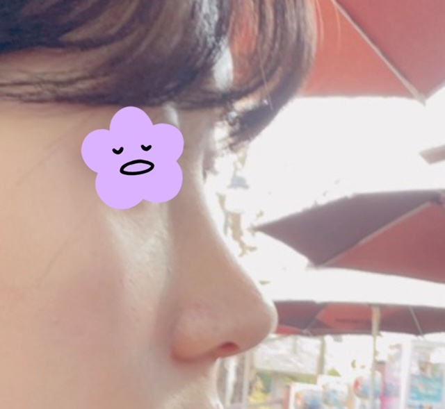 기능코성형+눈성형 잘된거같아요!!