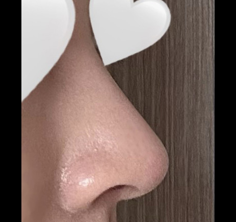 무보형물코성형 네달차!!