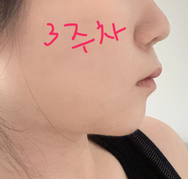 고민끝에 바이브에서 얼굴지방 뽑았습니당