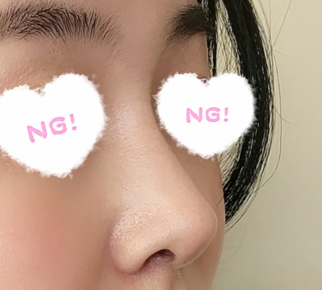 40대 코성형 후기올려요^^~