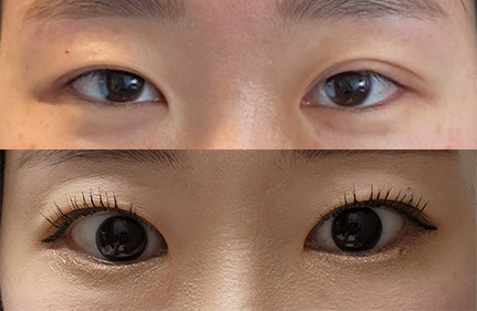 절개눈매교정 자리잘잡고 있어요!