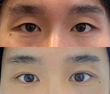 남자눈성형 바이브추천!