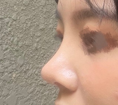 원장님실력덕분에 눈, 코잘됐어요 ㅎㅎ