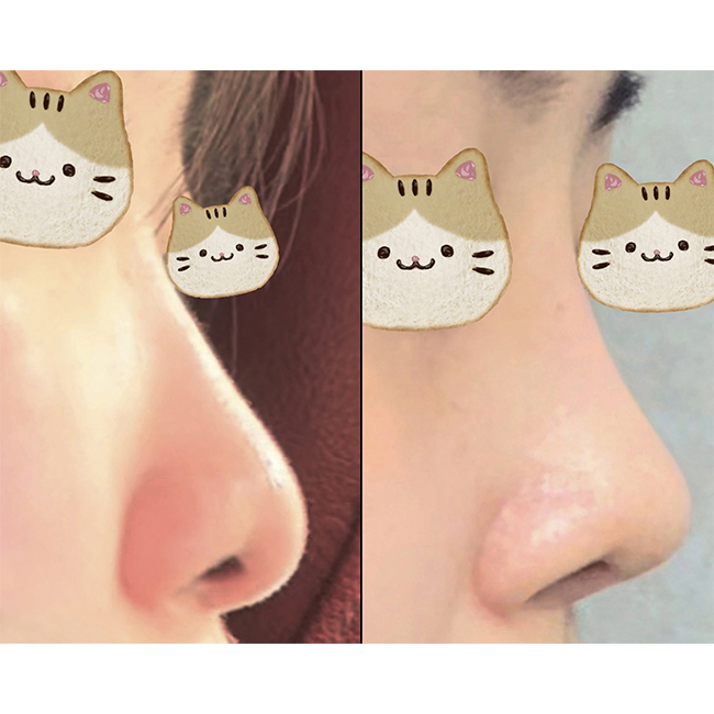 자가늑코성형 3주차됐어요!!