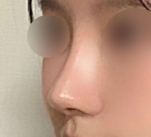 복코수술 성공후기><!!최공