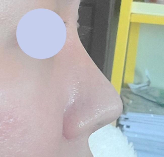 6개월차 수술후기씁니다:)