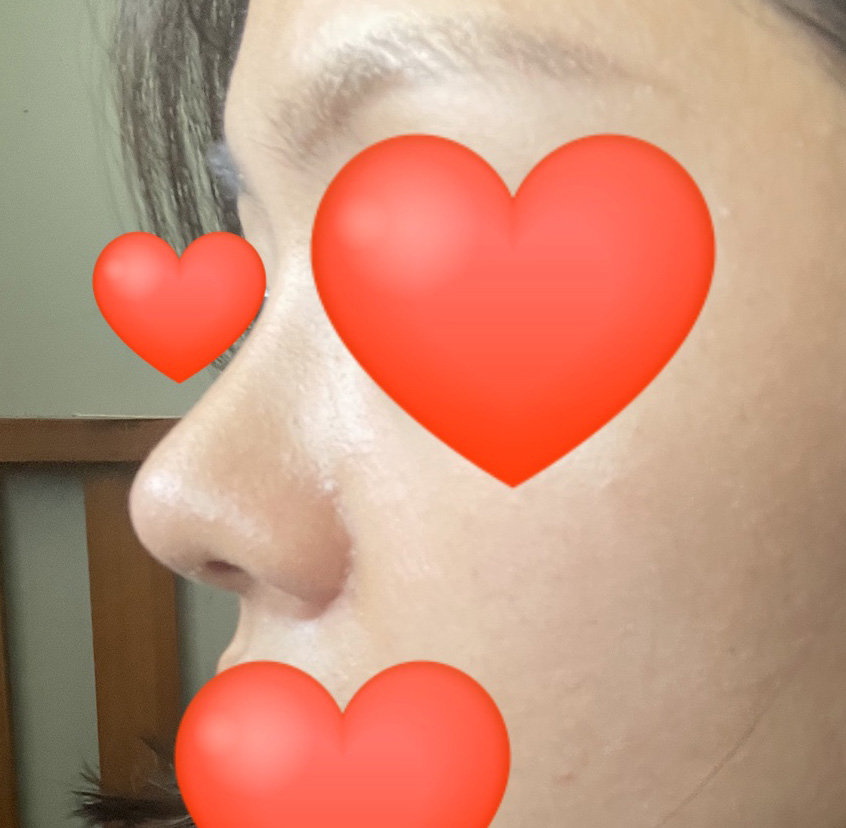 유원장님한테 코수술 받았습니다:)