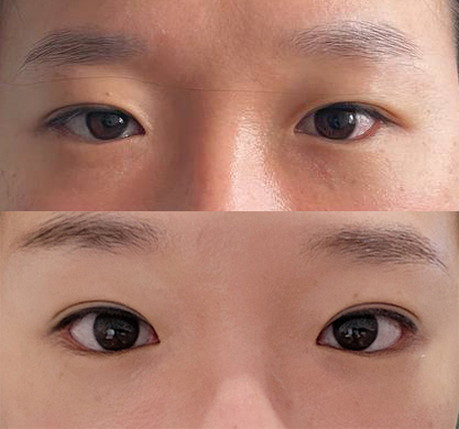 원하던 쌍꺼풀라인으로 만들어졌어요~