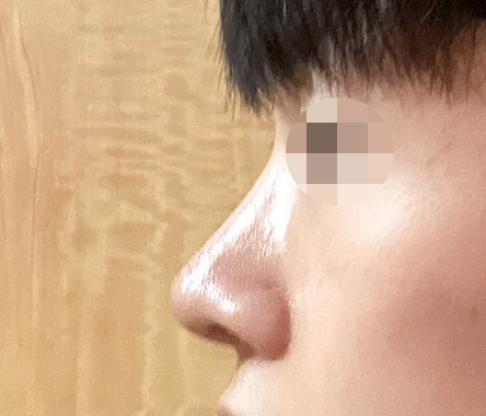 코 컴플렉스 이제 없어요