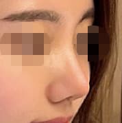 매부리코 한달차 만족해요 ㅎㅎㅎ