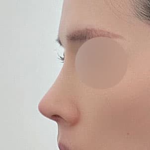 코 하나로 이미지가 고급져졌어요(+기증연골사용)