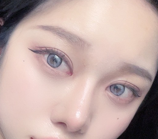 성형티안나면서 이쁘게 잘됐어요!(눈, 코 4개월차후기)