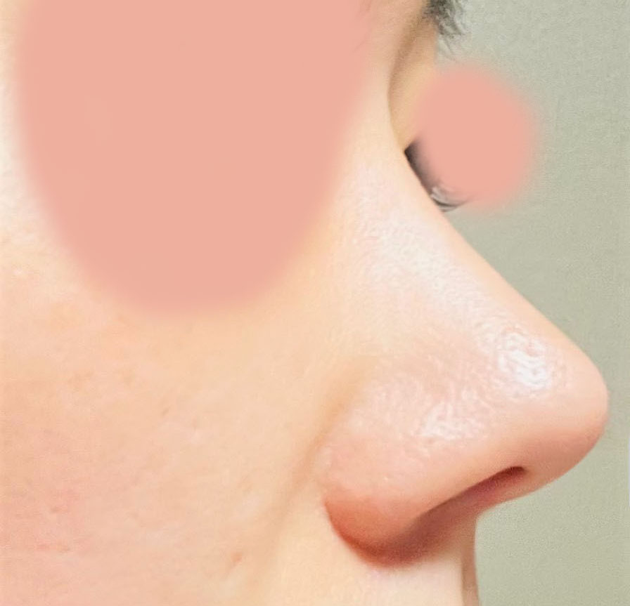 무보형물코성형한지 4달째에요:)