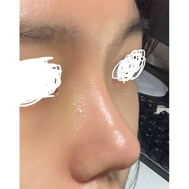 복코수술후기입니당!