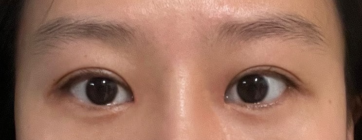 절개눈매교정이랑 앞트임,  눈밑지방재배치 후기 ㅎㅎ