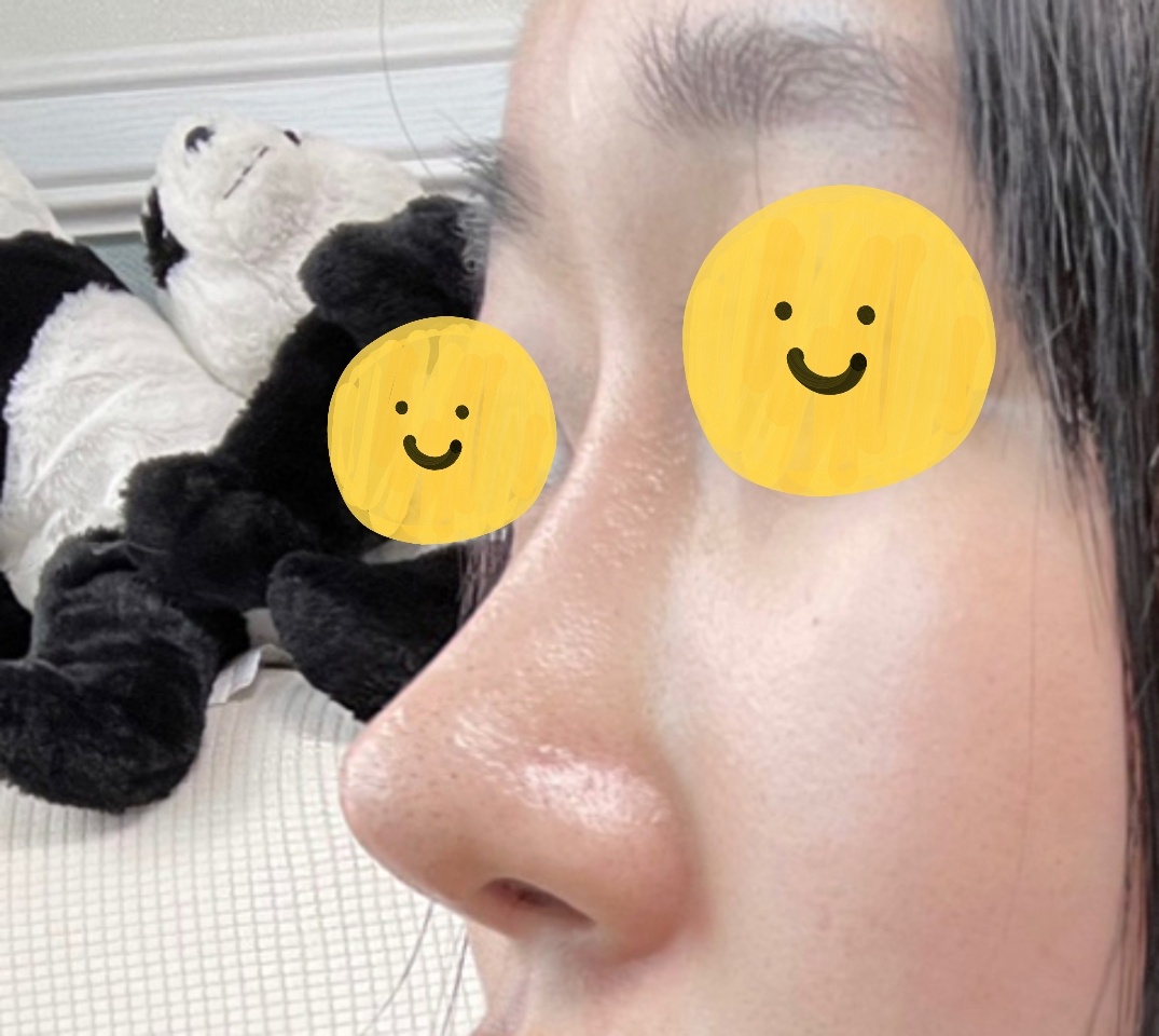 첫코수술+눈재수술한지  4개월지났어욤