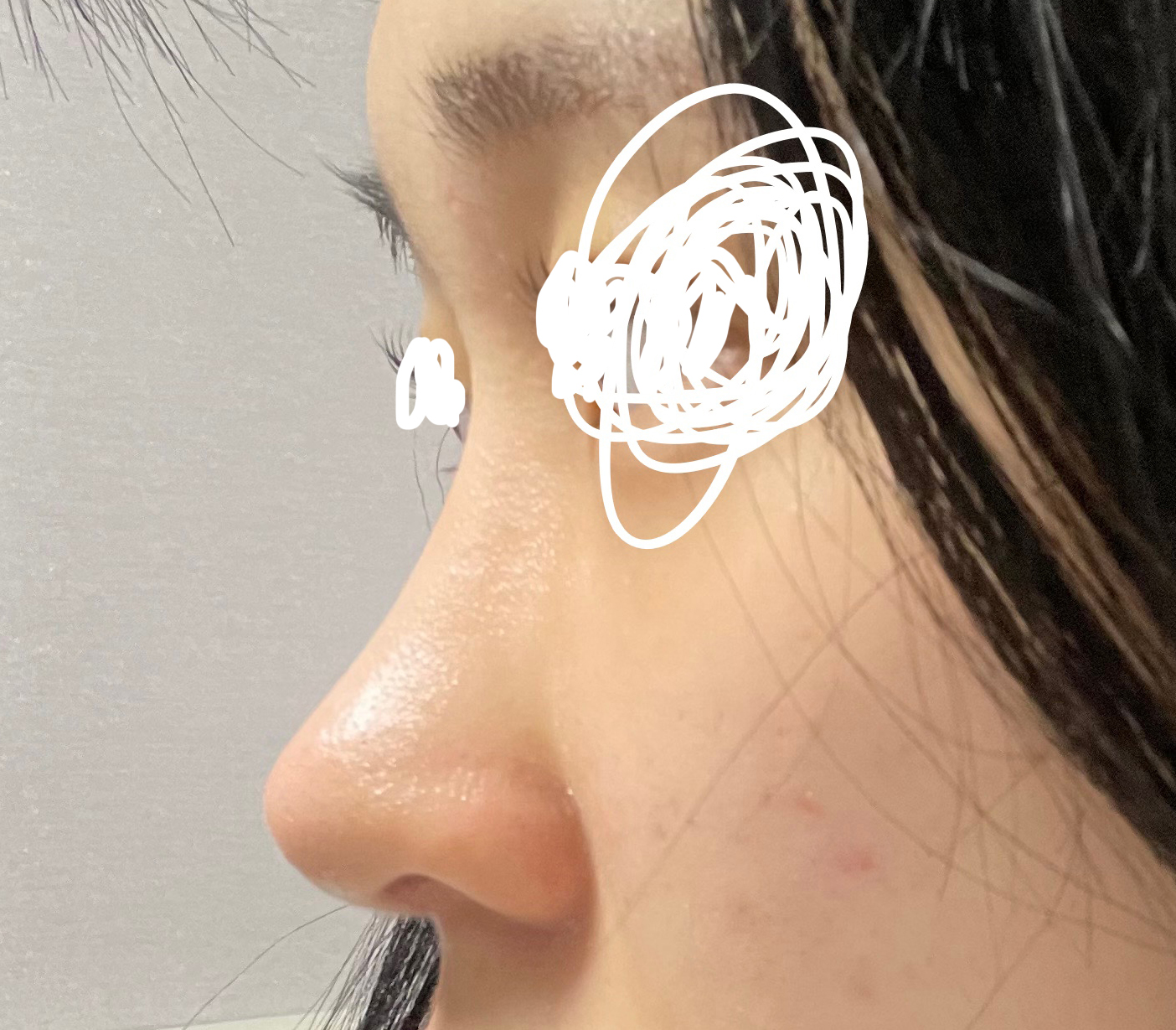 기능코수술/자연유착 눈재수술후기!