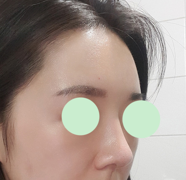 코수술/지방이식 3개월차됐슴당