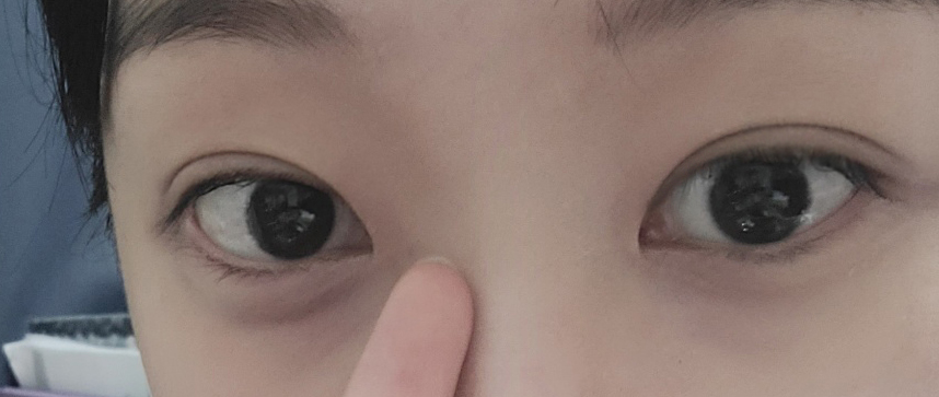 매몰 쌍수 + 앞트임 6개월이요!