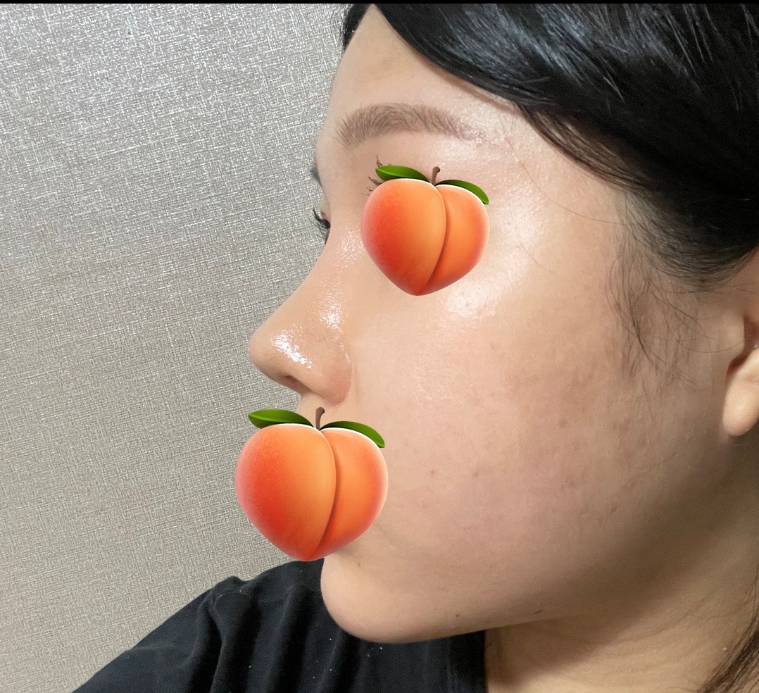 코재수술 성공적!!