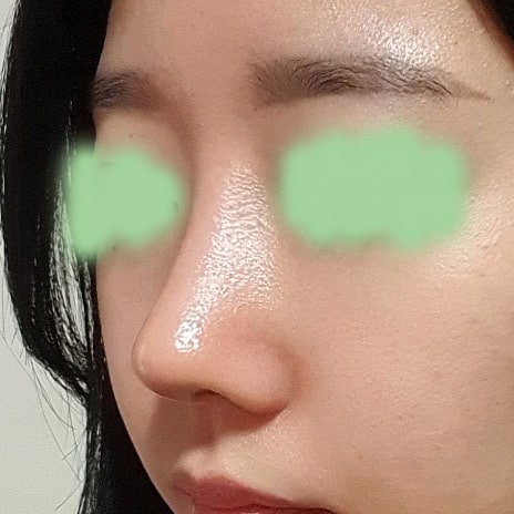 기증늑으로 코재수술 했슴돠