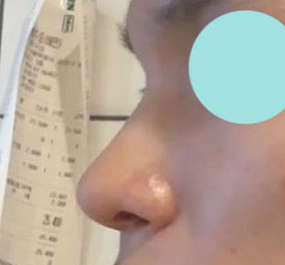 남자코성형도 바이브추천요!!