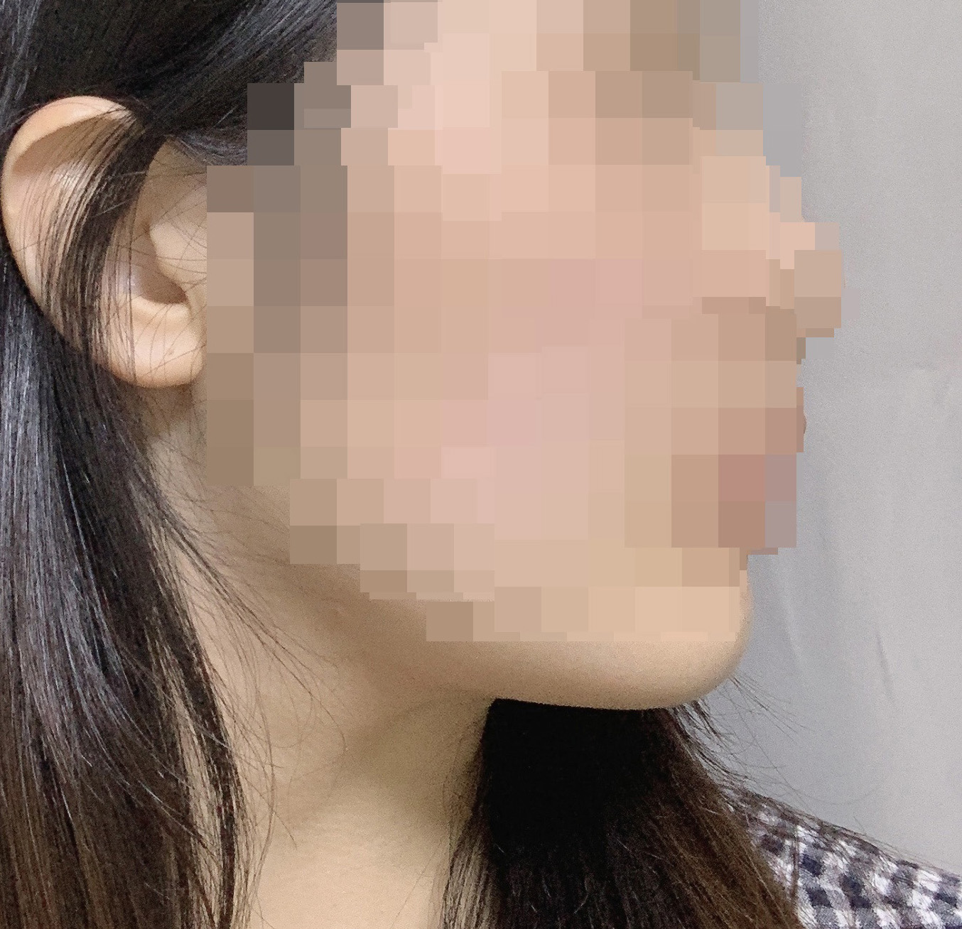 얼굴지흡맛집=바이브에요!!