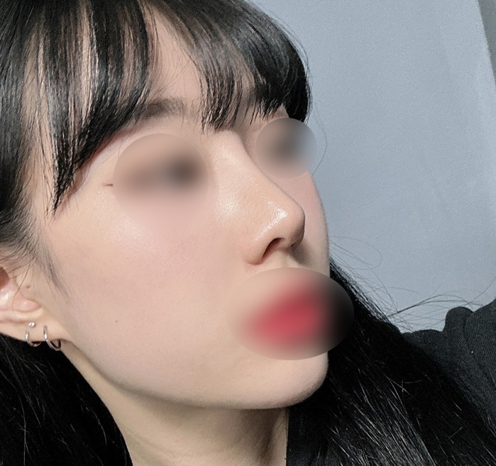 매부리코성형/눈트임 4개월차
