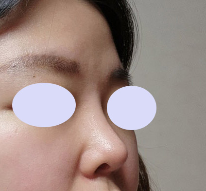 코수술 세달차:)