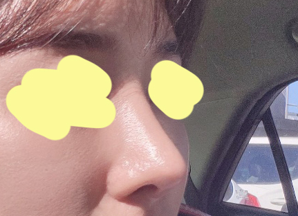 코수술 1개월차! 마음에 들어용