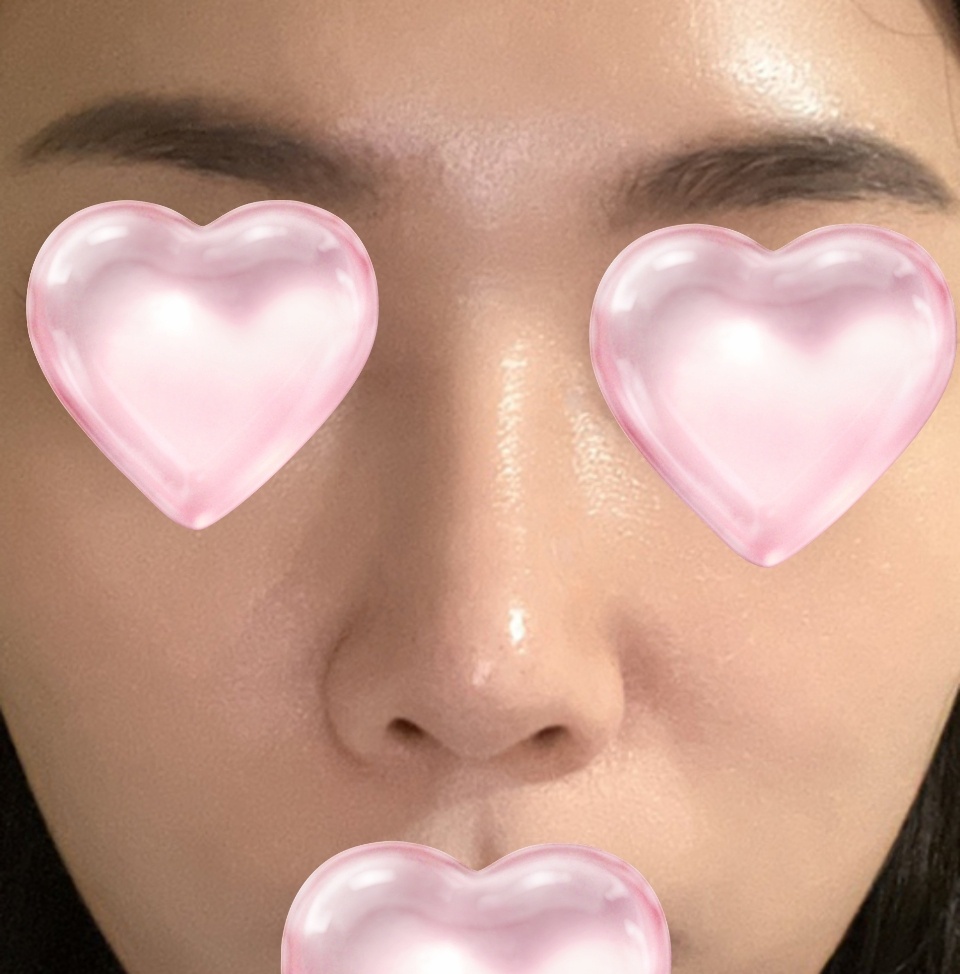 유원장님께 코성형받은지 5개월차접어드네요~!