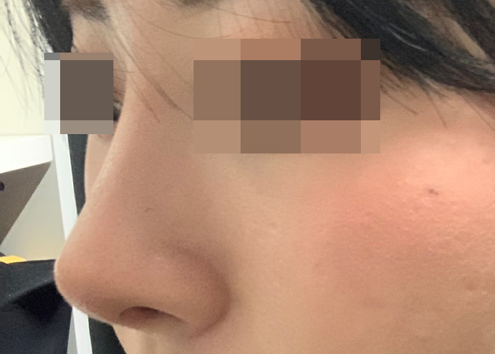 눈성형, 코성형 재수술 4달차됐어용