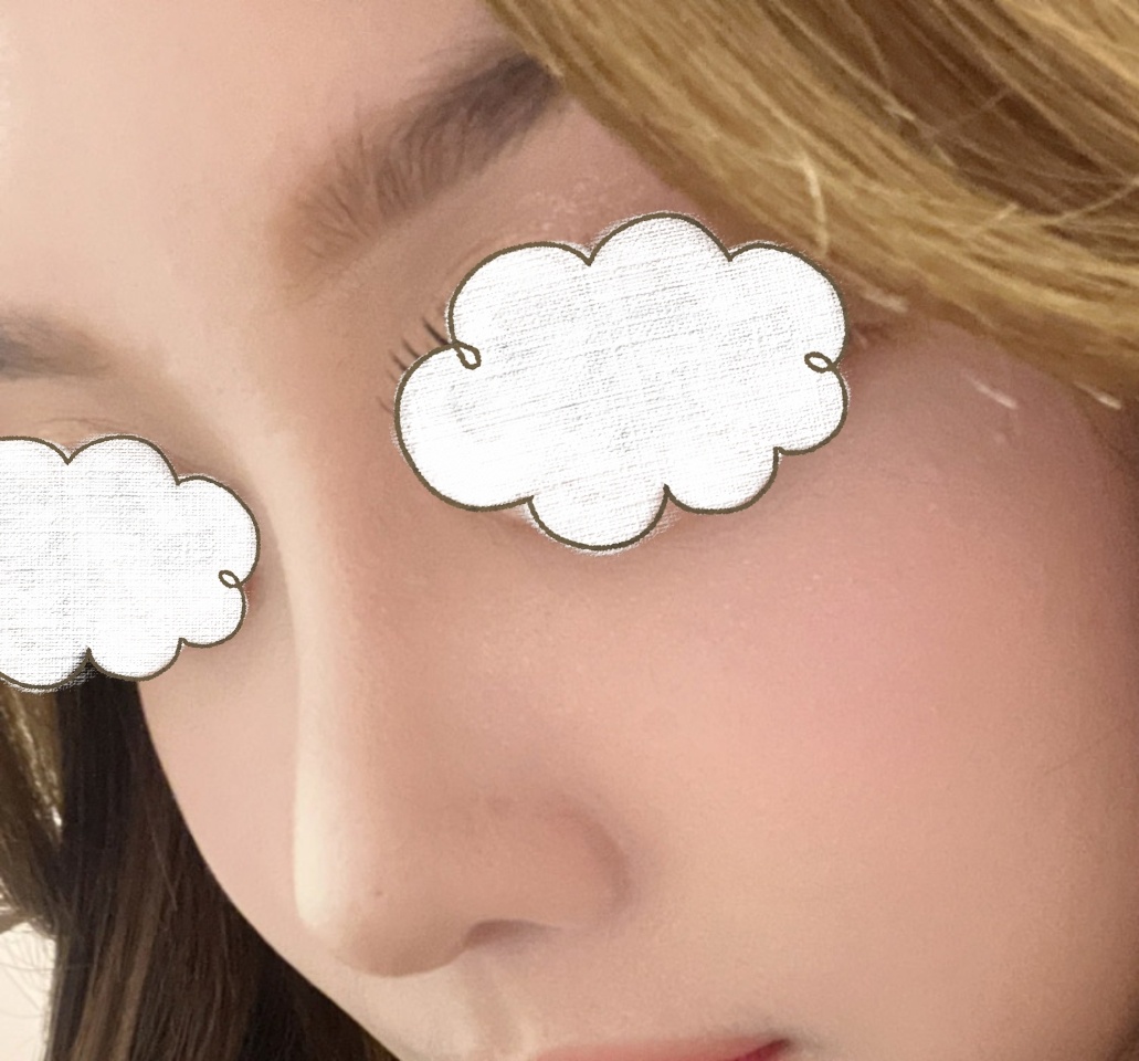 코수술 5개월차됐습니다