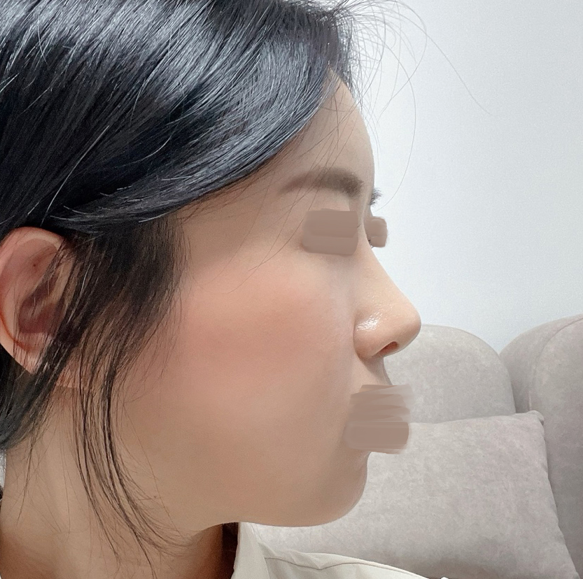 바이브에서 코랑 지방이식했어요!!